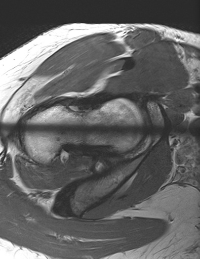 Figure 2 for case Subacute strain of the femoral insertion of anterior hip capsule